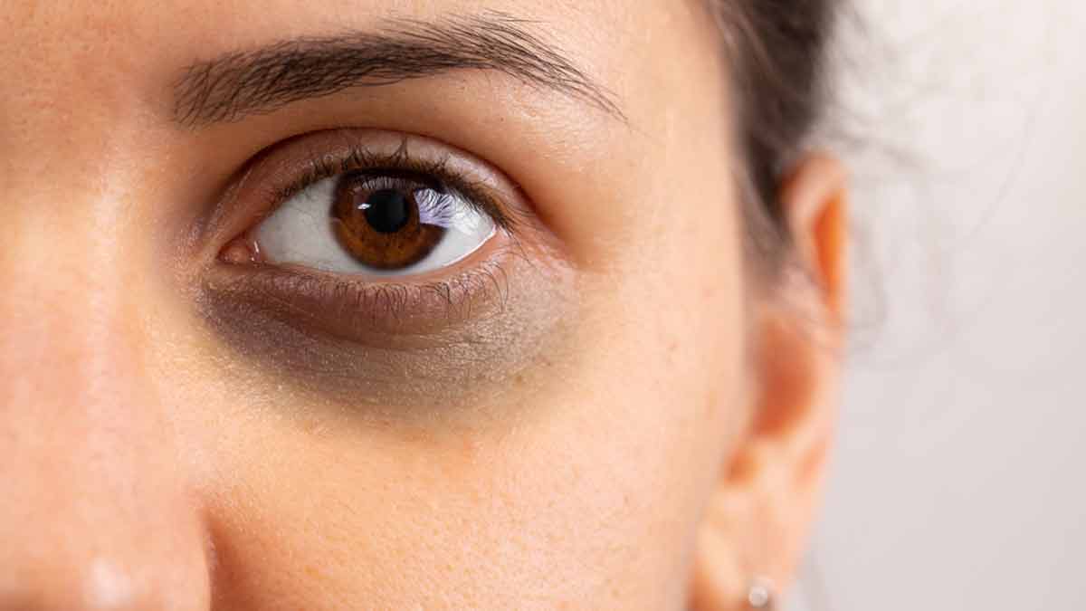Remove Dark Circles: கருவளையத்தை ஒரே வாரத்தில் நீக்க இந்த வீட்டு வைத்தியத்தை முயற்சியுங்க!