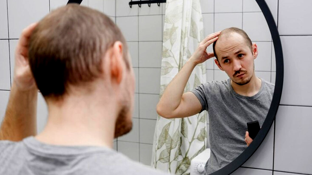 Teenage Balding: இளம் வயதிலேயே வழுக்கையா? இது தான் காரணம்!