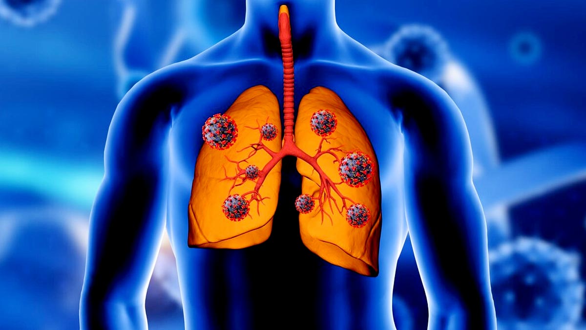 Pneumonia Recovery Tips: இத மட்டும் செய்யுங்க! நிமோனியாவை ஈஸியா எதிர்கொள்ளலாம்