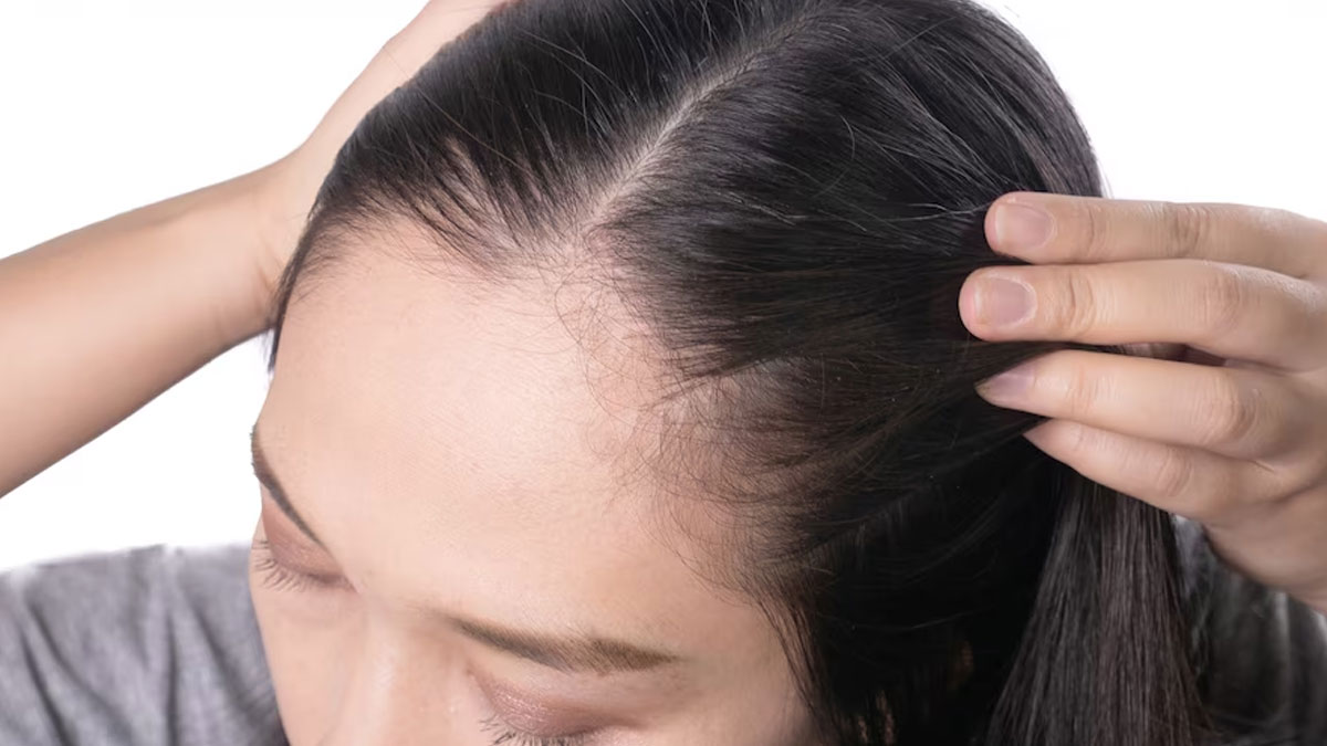 Acne On Scalp: தலையில் கொப்புளங்கள் வருகிறதா? இதோ எளிய வீட்டு வைத்தியம்!