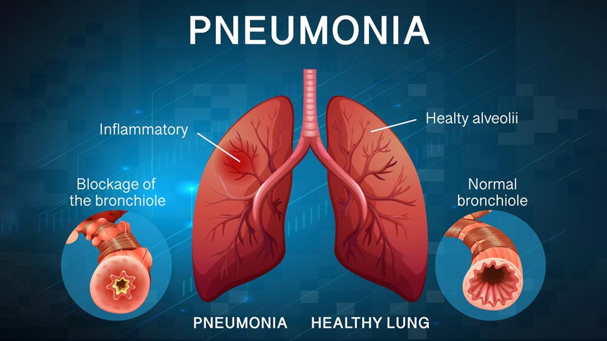 Causes Of Pneumonia: நிமோனியா வருவதற்கு காரணம் என்ன? அது எவ்வளவு தீவிரமானது?