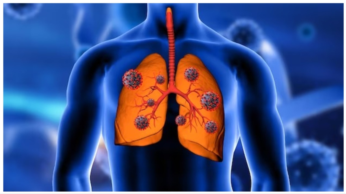 COPD: புகைப்பிடிக்காதவர்களுக்கு கூட நுரையீரல் பாதிக்கப்பட வாய்ப்புள்ளது - எப்படி?