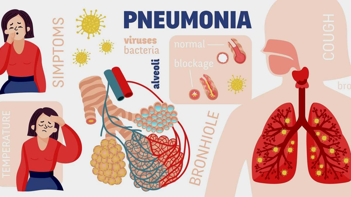 Complications Of Pneumonia: நிமோனியாவின் தீவிர சிக்கல் இது தான்!
