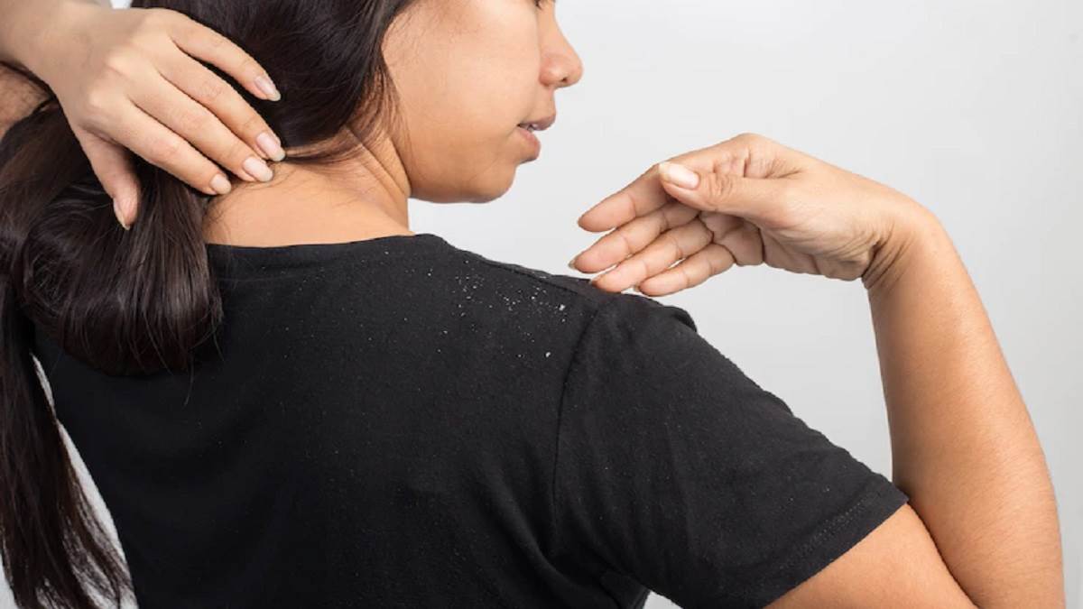 Apple Cider Vinegar for Dandruff: பொடுகை போக்க ஆப்பிள் சைடர் வினிகரை எப்படி பயன்படுத்தனும் தெரியுமா?