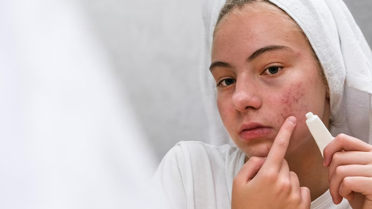 Aloe Vera for Acne: கரும்புள்ளிகள் உங்கள் அழகை கெடுக்கிறதா? கற்றாழை ஜெல்லை இப்படி யூஸ் பண்ணுங்க!