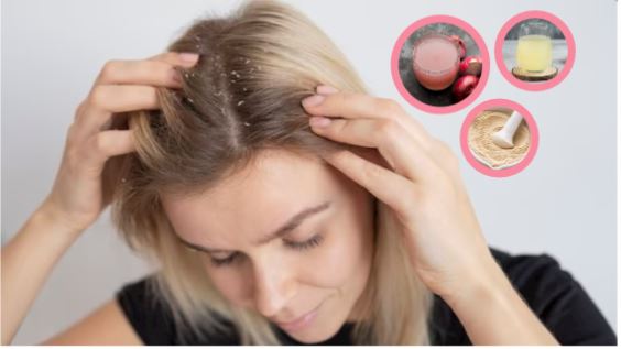 Hair Care: 15 நாட்களில் பொடுகு தொல்லையில் இருந்து விடுதலை… எளிய குறிப்புகள் இதோ!