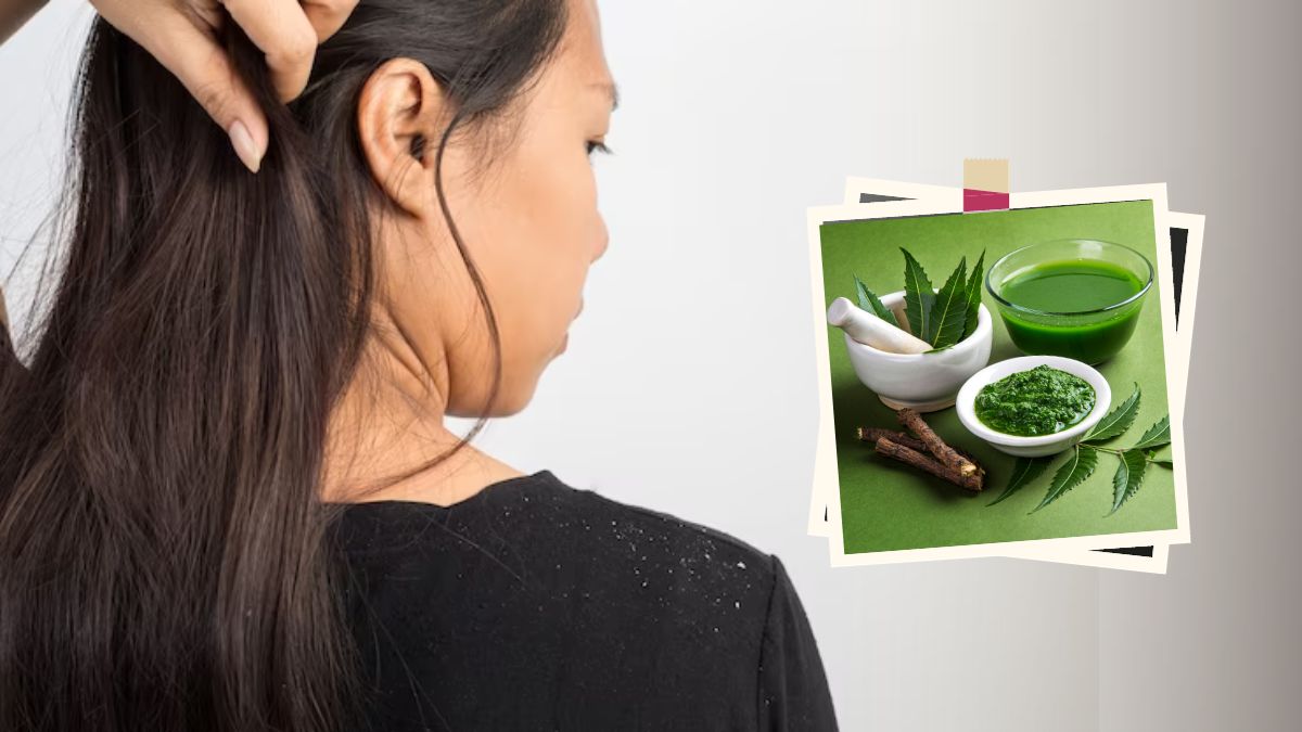 Veppilai For Dandruff: பொடுகு தொல்லையிலிருந்து சீக்கிரம் விடுபட வேப்பிலையை இந்த வழிகளில் பயன்படுத்துங்க.