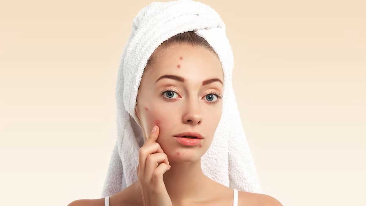 how-to-remove-pimples-marks-in-one-day-get-rid-of-pimple-scars-with