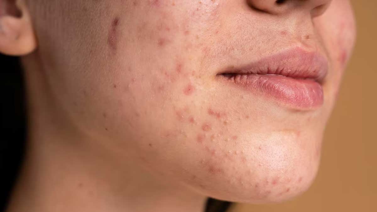 Summer SkinCare: கோடை சரும பிரச்சனையை போக்க வெள்ளரிக்காய், மஞ்சள் போதும்.. இதை செய்யுங்க!