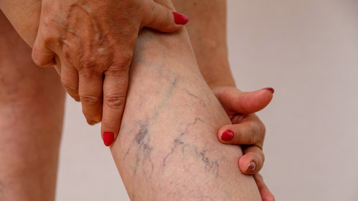 Leg Veins Problem: கால் நரம்பில் ஏற்படும் பிரச்சனையும், இதயத்தில் ஏற்படும் விளைவுகளும்..