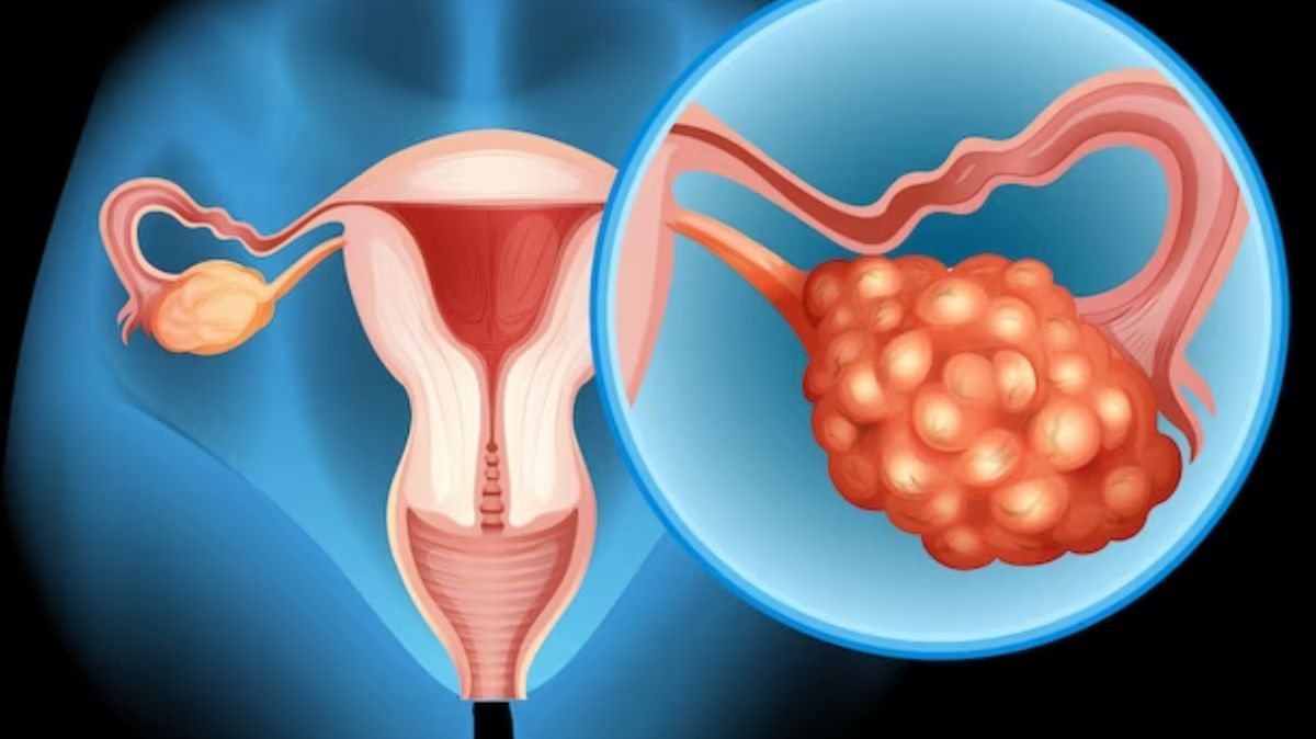 PCOS Exercise: பிசிஓஎஸ் இருக்குன்னு கவலையா? இத பண்ணுங்க போதும்!
