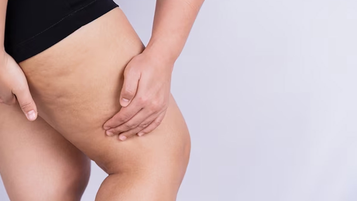 Thighs Burning: ரெண்டு தொடையும் உரசி, உரசி ஏற்பட்ட காயத்துக்கு வீட்டிலேயே இருக்கு சூப்பர் தீர்வு!
