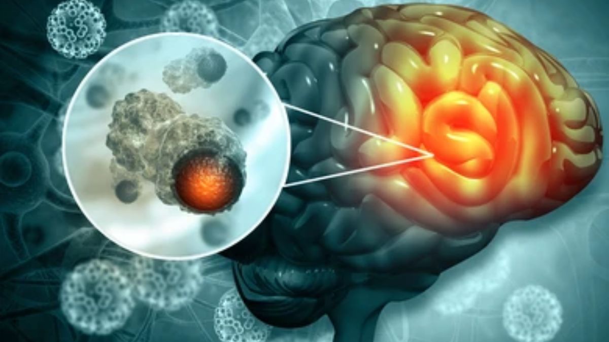 Brain Tumor: இந்த தவறுகளை செய்தால் பிரைன் டியூமர் வரலாம்.!