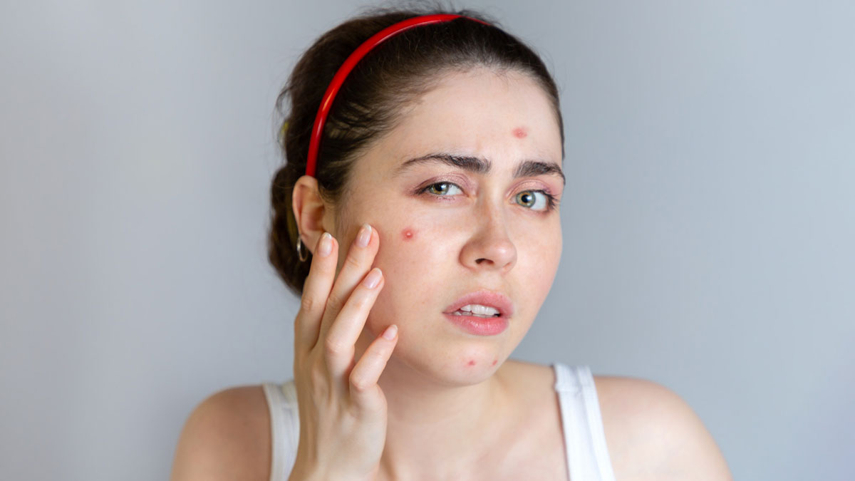 Pimple Treatment: பருக்கள் பிரச்சனையில் இருந்து விடுபட உதவும் ஆயுர்வேத வைத்தியம்!