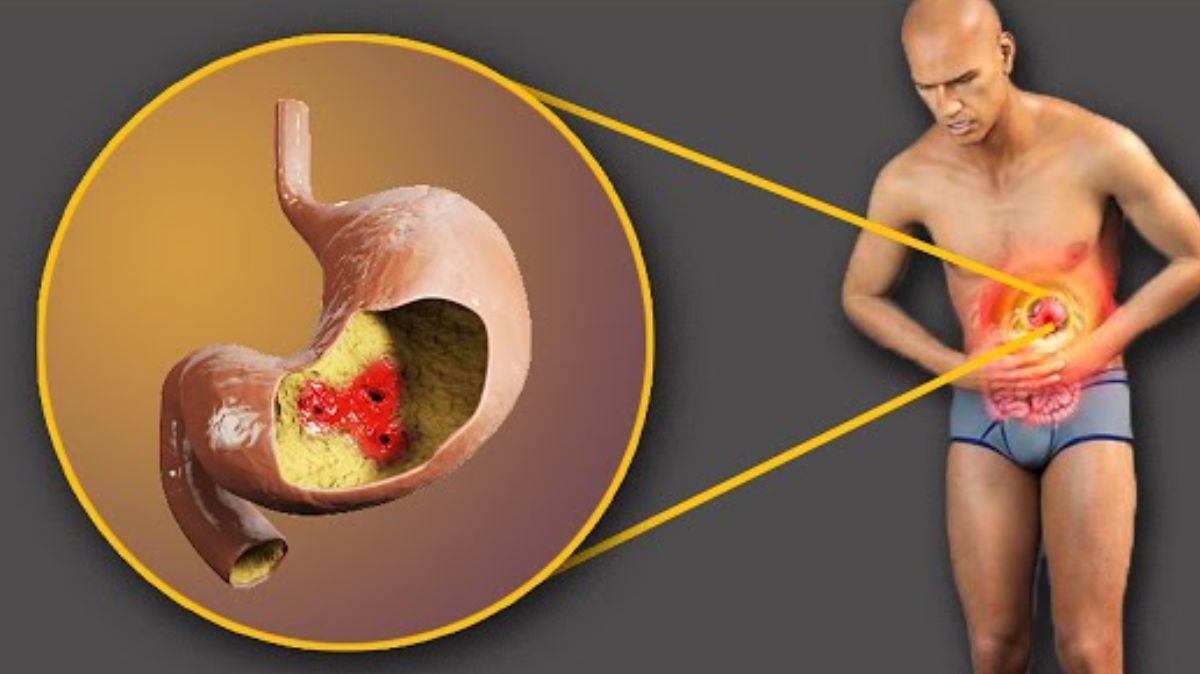 Stomach Ulcer: அல்சரின் அறிகுறிகள், காரணங்கள் மற்றும் சிகிச்சை…