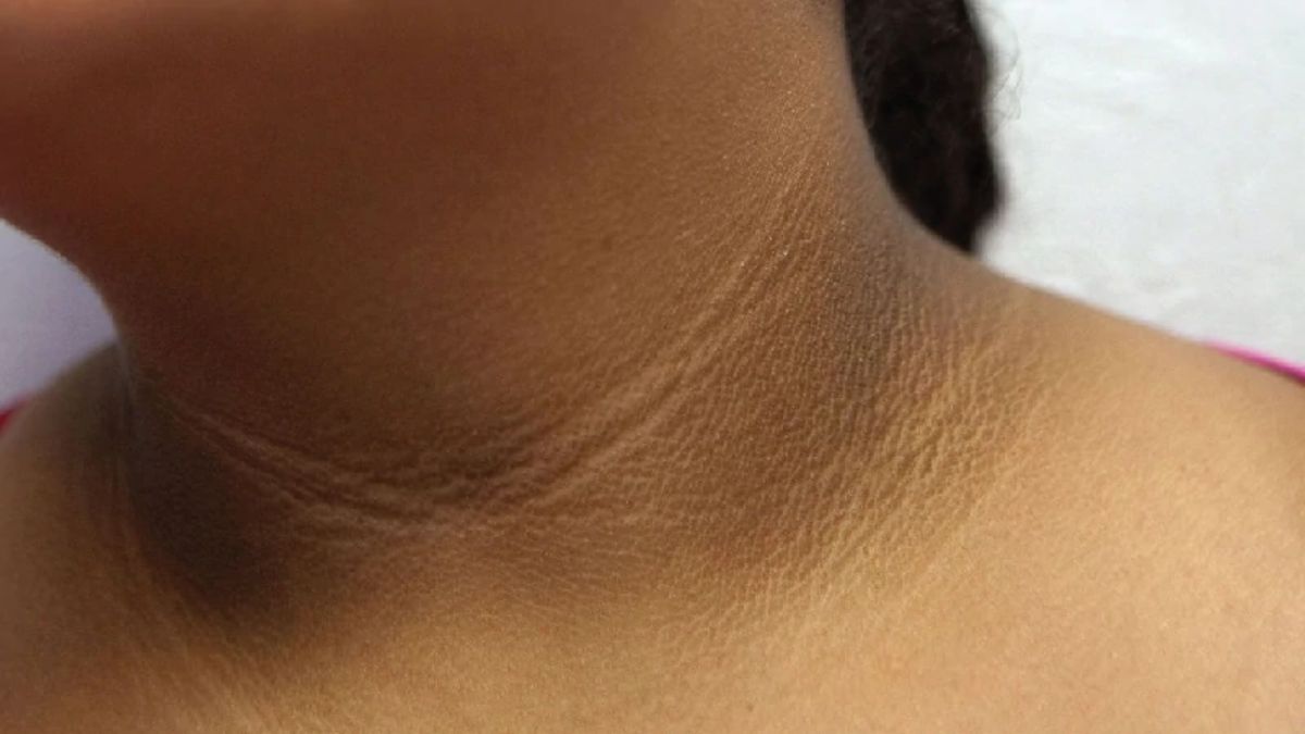 Dark Neck: கழுத்தின் கருமை நிறம் நீங்க வீட்டிலேயே இதை செய்யுங்கள்!