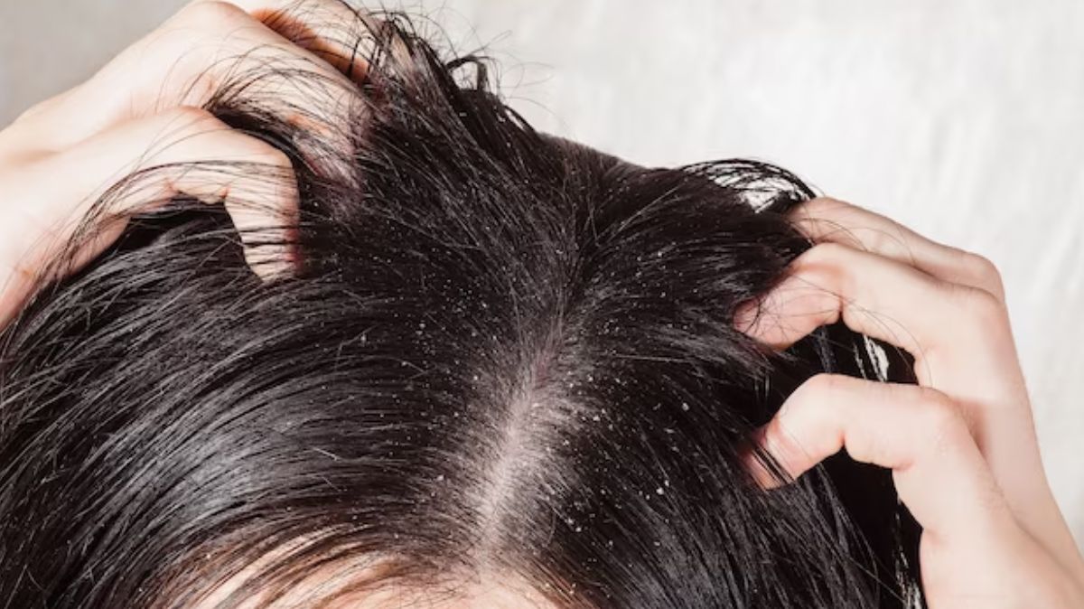 Summer Hair Care: கோடையில் பொடுகை குறைக்க உதவும் சிறந்த ஹேர் மாஸ்க்!