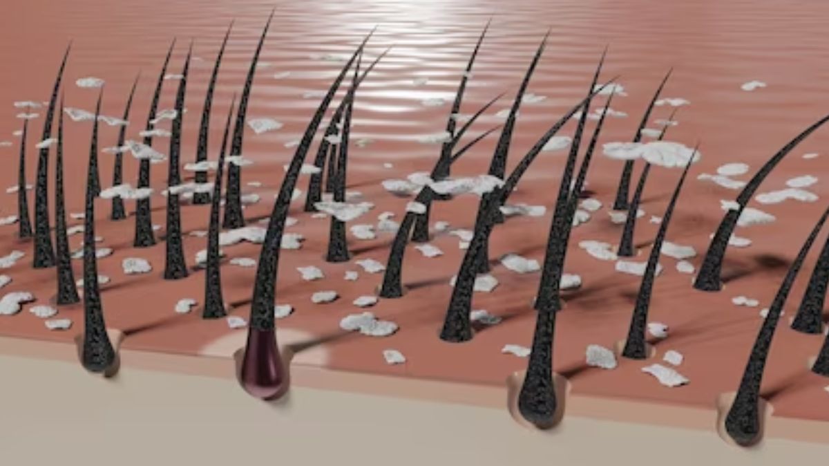 Dandruff Problem: பொடுகு தொல்லையால் அவதியா.? இது மட்டும் போதும்.!
