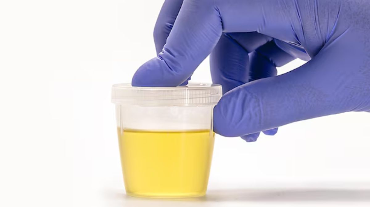 yellow urine: வெயில் காலத்தில் சிறுநீர் மஞ்சள் நிறமாக இருப்பது இயல்பானதா?