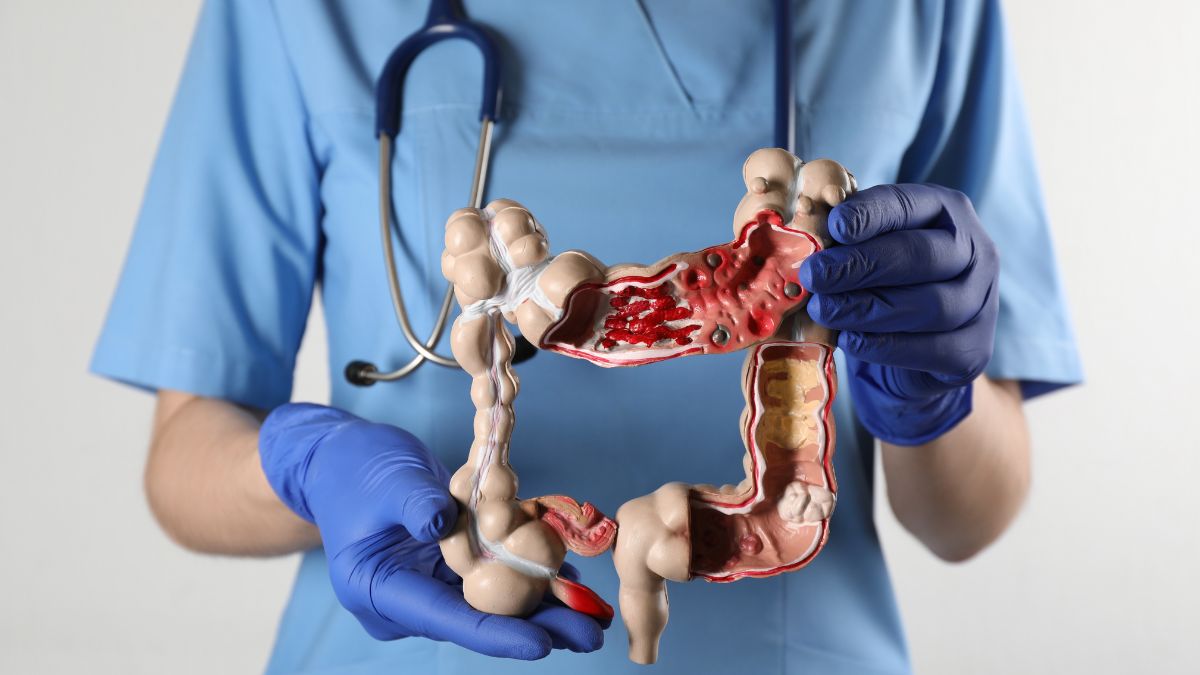 Colon Cancer Symptoms: இளம் வயதினரைப் பாதிக்கும் பெருங்குடல் புற்றுநோய்க்கான அறிகுறிகளும், காரணங்களும்