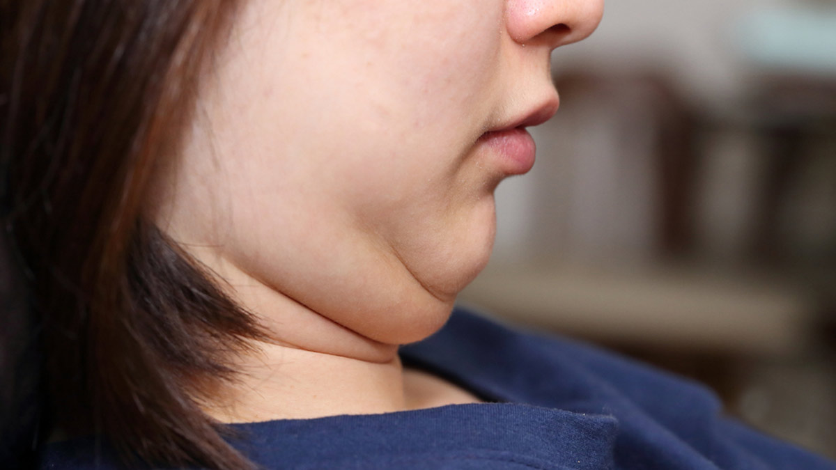 Double Chin: டபுள் சின் உங்க அழகை கெடுக்கிறதா? இந்த 2 பயிற்சிகளை தினமும் செய்யுங்க!