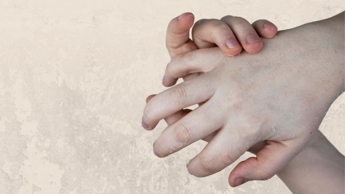 Peeling Skin On Hands: கைகளில் தோல் உரிதல் ஏற்பட என்ன காரணம் தெரியுமா?