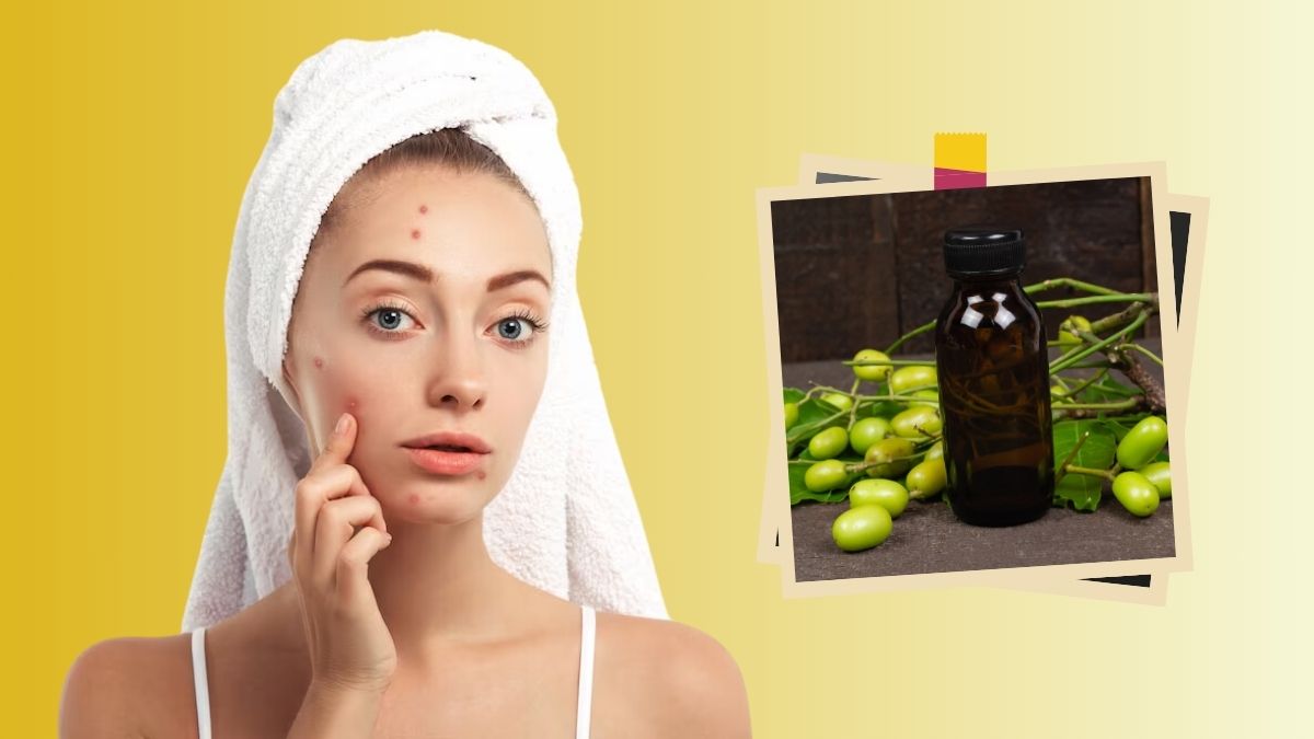Neem For Acne: முகப்பரு இருந்த இடம் தெரியாமல் போக இந்த ஒரு ஃபேஸ் பேக் யூஸ் பண்ணுங்க