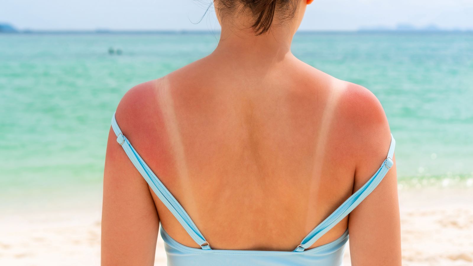 Remedies for Sunburn: கொளுத்தும் வெயிலில் முகம் அடையாளம் தெரியாமல் மாறிவிட்டதா? ஒரே இரவில் சன் பர்ன் நீங்க டிப்ஸ்!