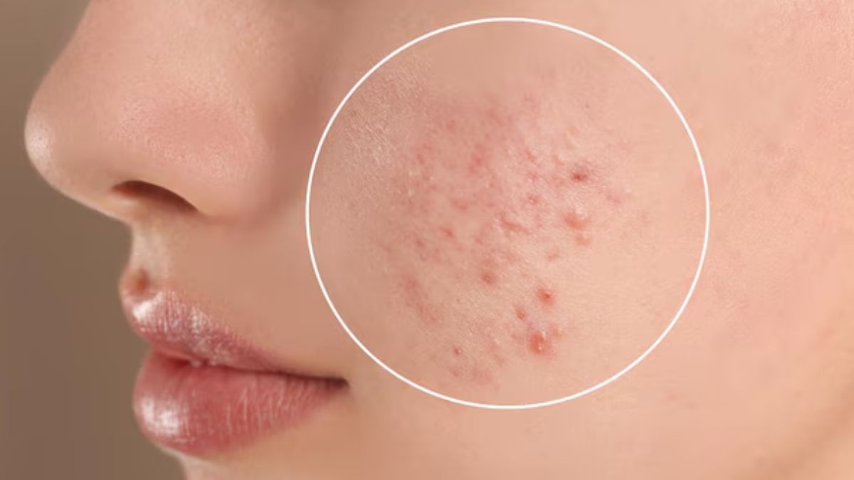 Acne Prevention Tips: முகப்பரு நீங்க சூப்பர் வீட்டு வைத்தியம்!