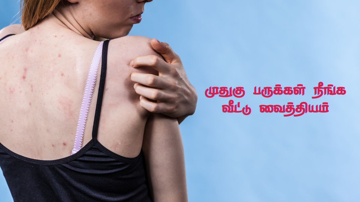 Back Acne Remedies: முதுகு பருக்களால் அவதியா? ஒரே இரவில் பருக்களைக் குறைக்க இதுல ஒன்னு யூஸ் பண்ணுங்க!