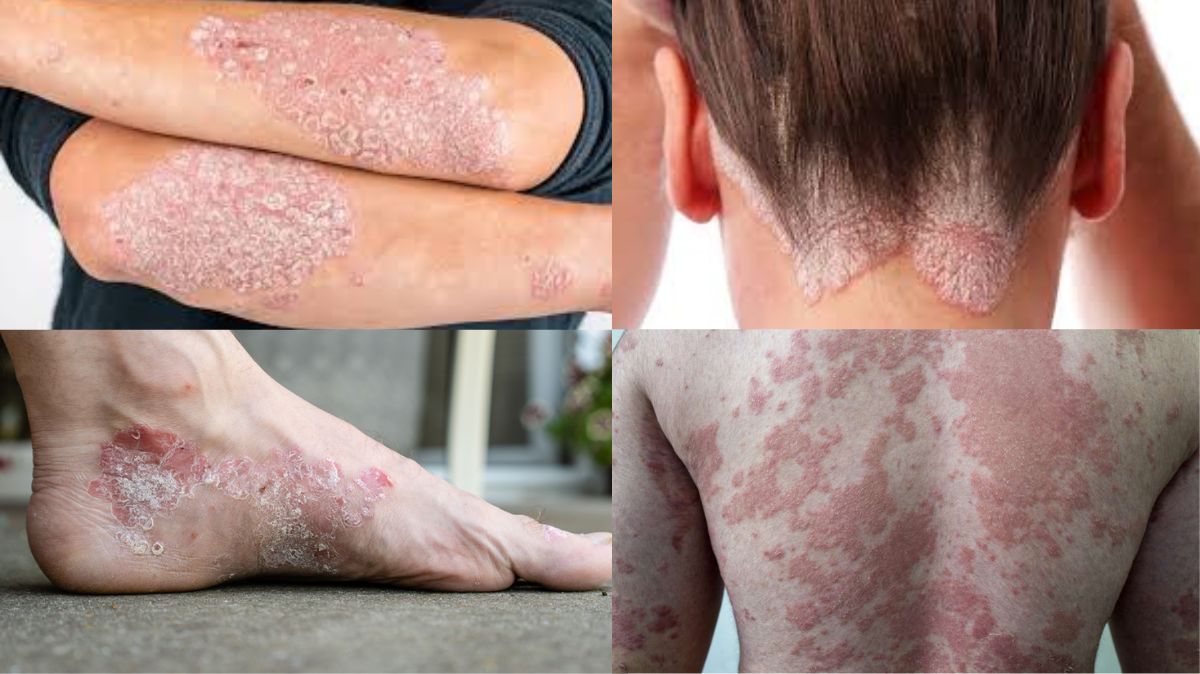 Psoriasis Diet: சொரியாசிஸ் நோயாளிகள் சாப்பிட வேண்டிய உணவுகள்
