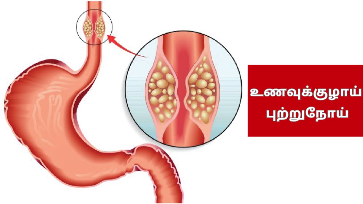 Esophageal Cancer: உயிர் பறிக்கும் உணவுக்குழாய் புற்றுநோய்.! புகைபிடிப்பது தான் காரணமா.?