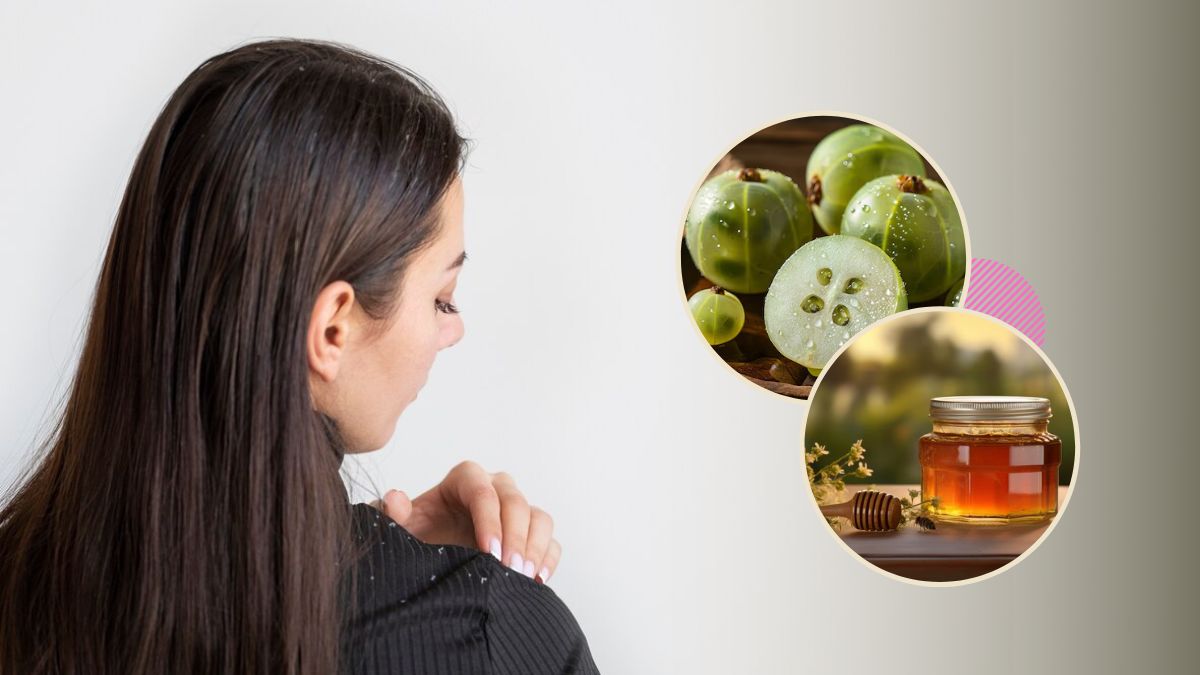 Amla For Hair: பொடுகுத் தொல்லை நீங்க நெல்லிக்காயுடன் இந்த ஒரு பொருளை யூஸ் பண்ணுங்க