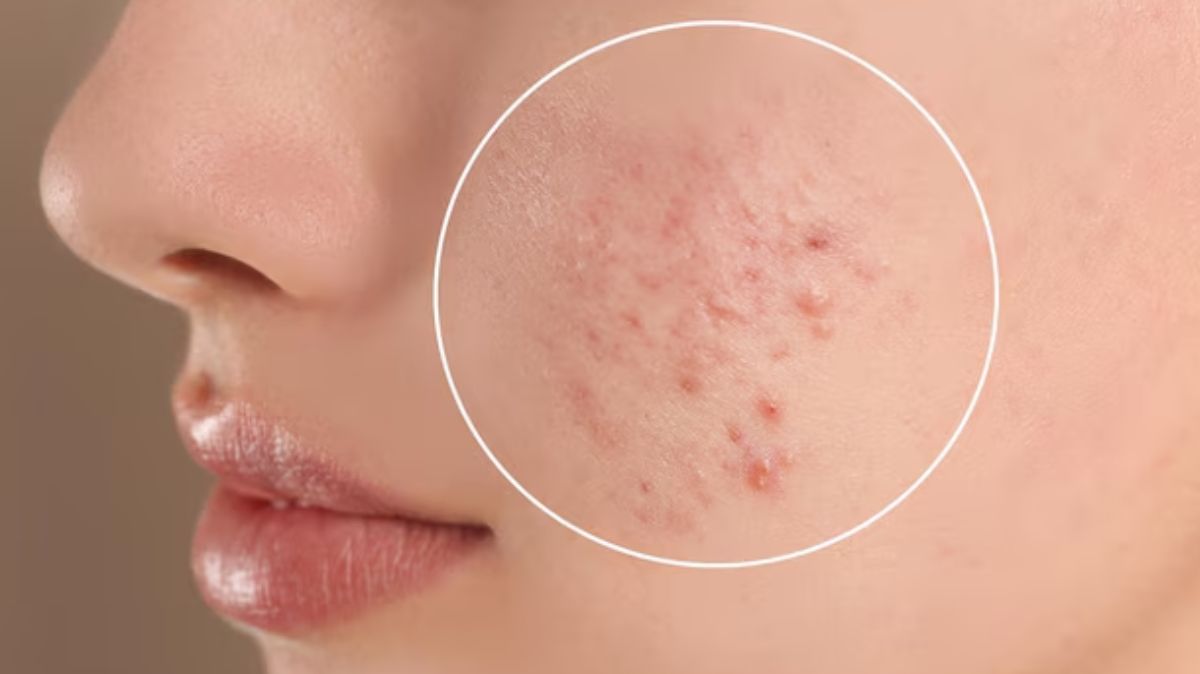 Home Remedies For Acne: முகப்பருவை குணப்படுத்தும் அற்புதமான வீட்டு வைத்தியம் இங்கே.!