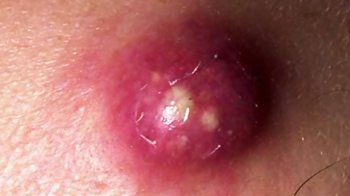 Vaginal Pimples: பிறப்புறுப்பில் பருக்கள் இருக்கிறதா.? சமாளிக்க சூப்பர் டிப்ஸ் இங்கே..