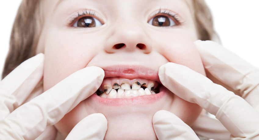 Dental Hygiene: உங்க குழந்தைகளை பல் சொத்தையிலிருந்து பாதுகாப்பது எப்படி? இதோ உங்களுக்கான டிப்ஸ்!