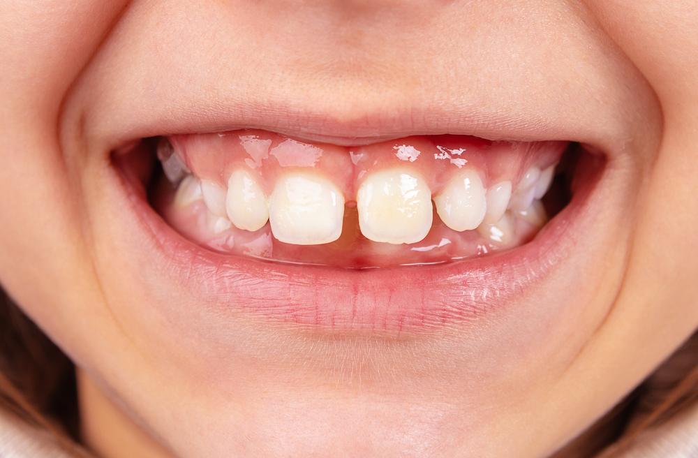 Teeth Gaps: பற்களுக்கு இடையில் ஏன் இடைவெளி ஏற்படுகிறது? இதனால் ஏற்படும் தீமைகளை பற்றி தெரியுமா?