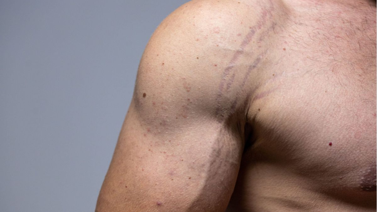 Stretch Marks Causes: தோலில் ஸ்ட்ரெட்ச் மார்க்ஸ் ஏன் ஏற்படுகிறது? எப்படி சரிசெய்வது?