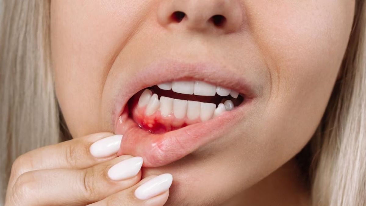 Bleeding Gums: பல் ஈறுகளில் இரத்தக் கசிவா? அதுக்கு இது தான் காரணம்! எப்படி தவிர்ப்பது?