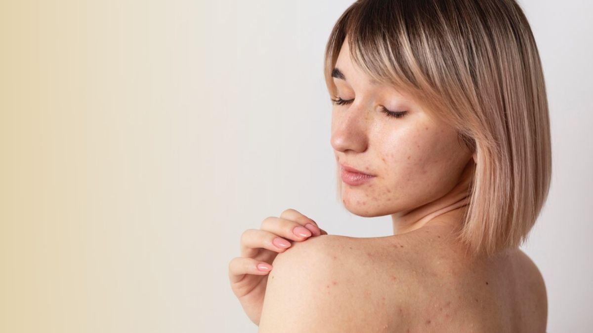 Body Acne Remedies: உடலில் தோன்றும் கொப்புளங்களை சரி செய்ய இந்த 5 பொருள்கள் போதும்!