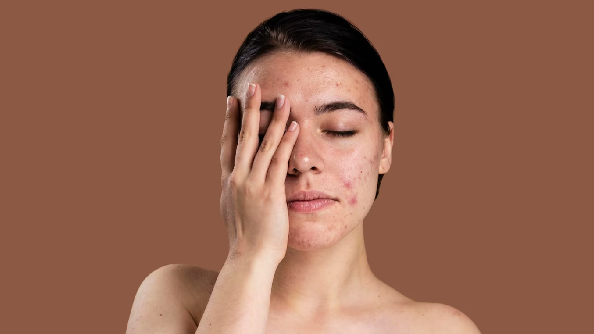 Black Spots on Skin: முகத்தில் உள்ள கரும்புள்ளிகளை குறைக்க இதை ட்ரை பண்ணுங்க!!