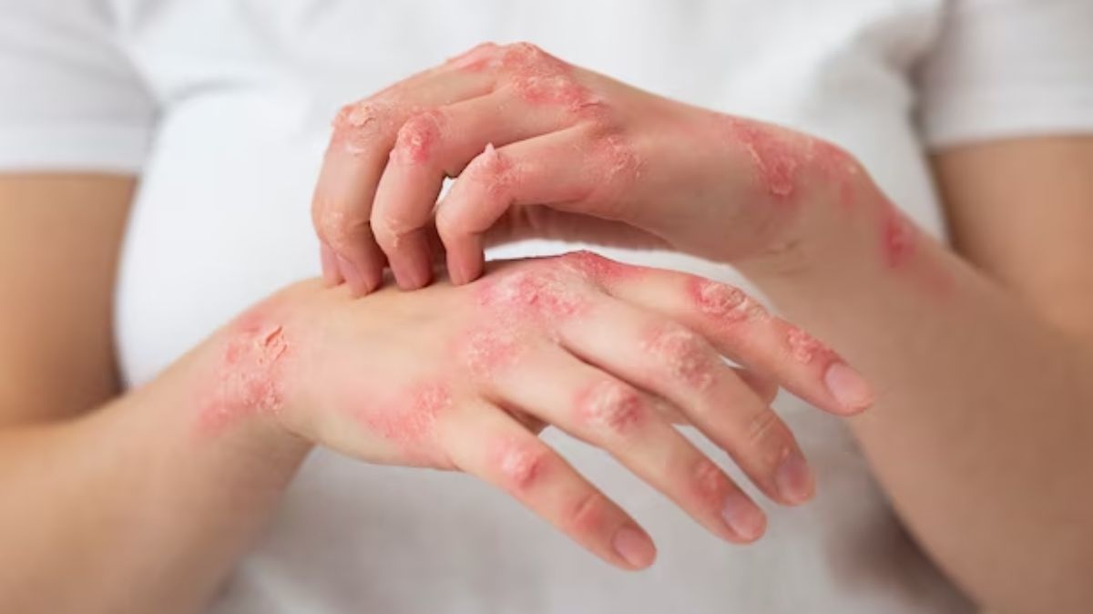 Scleroderma: உடலை இறுக்கமாக்கும் ஸ்க்லெரோடெர்மா.! இதை குணப்படுத்த முடியுமா.? மருத்துவரின் விளக்கம் இங்கே..