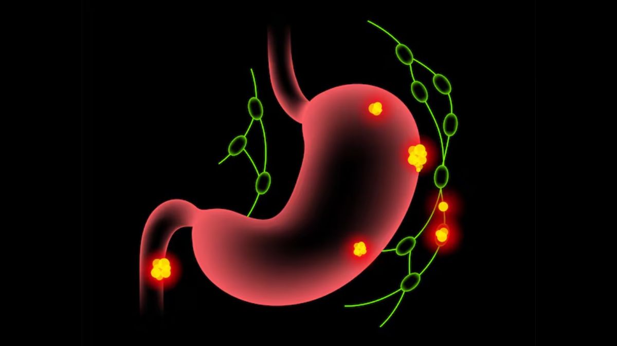 Stomach Ulcer Remedies: ஆயுசுக்கும் அல்சர் தொல்லை இல்லை.. அதான் இது இருக்கே..