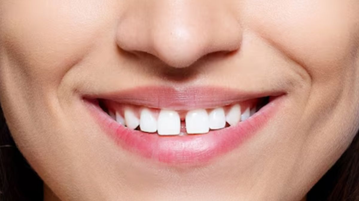 Gap Teeth Remedies: முன் பற்கள் இடைவெளியை சரி செய்ய சூப்பர் டிப்ஸ்.!