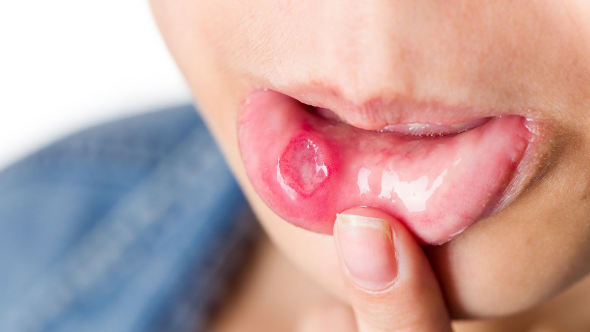 Mouth Ulcer Remedies: வாய் புண் வேகமாக குணமாக என்னென்ன சாப்பிடலாம்!