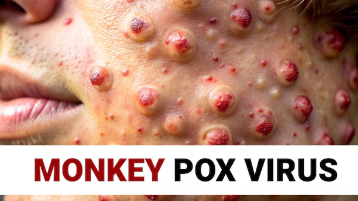 Mpox: குரங்கு அம்மை ஒருவரிடமிருந்து ஒருவருக்கு எப்படி பரவுகிறது தெரியுமா?