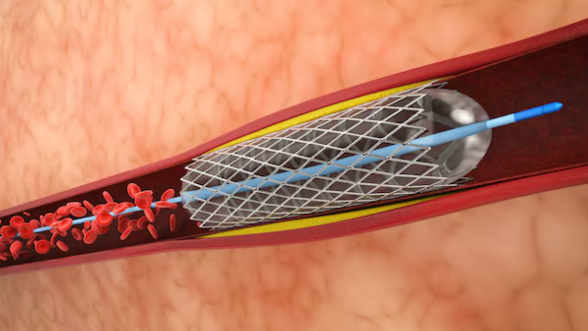 Stent: ரஜினிகாந்த் உடலில் இருக்கும் ஸ்டென்ட்! ஸ்டென்ட் என்றால் என்ன தெரியுமா?