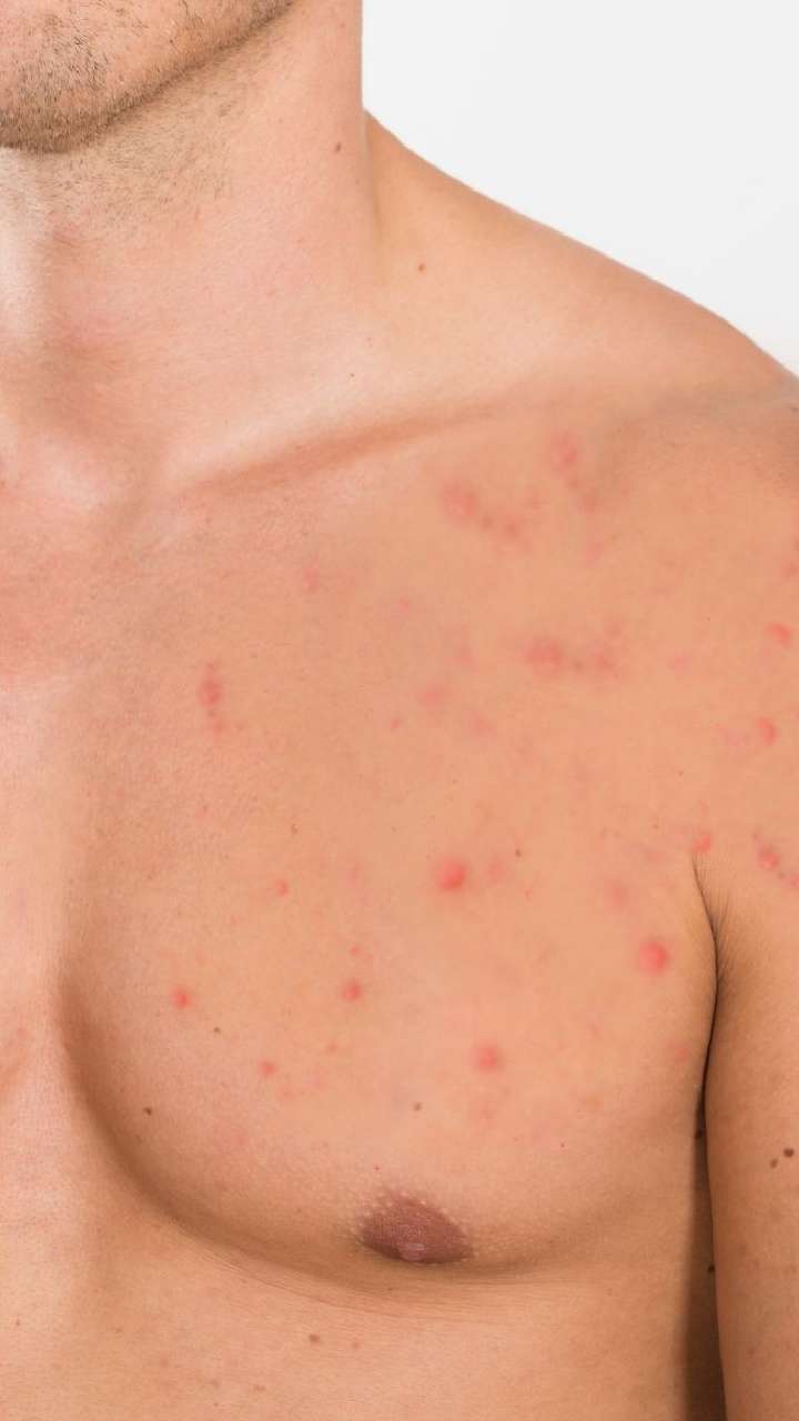 6 Effective Home Remedies To Get Rid Of Chest Acne