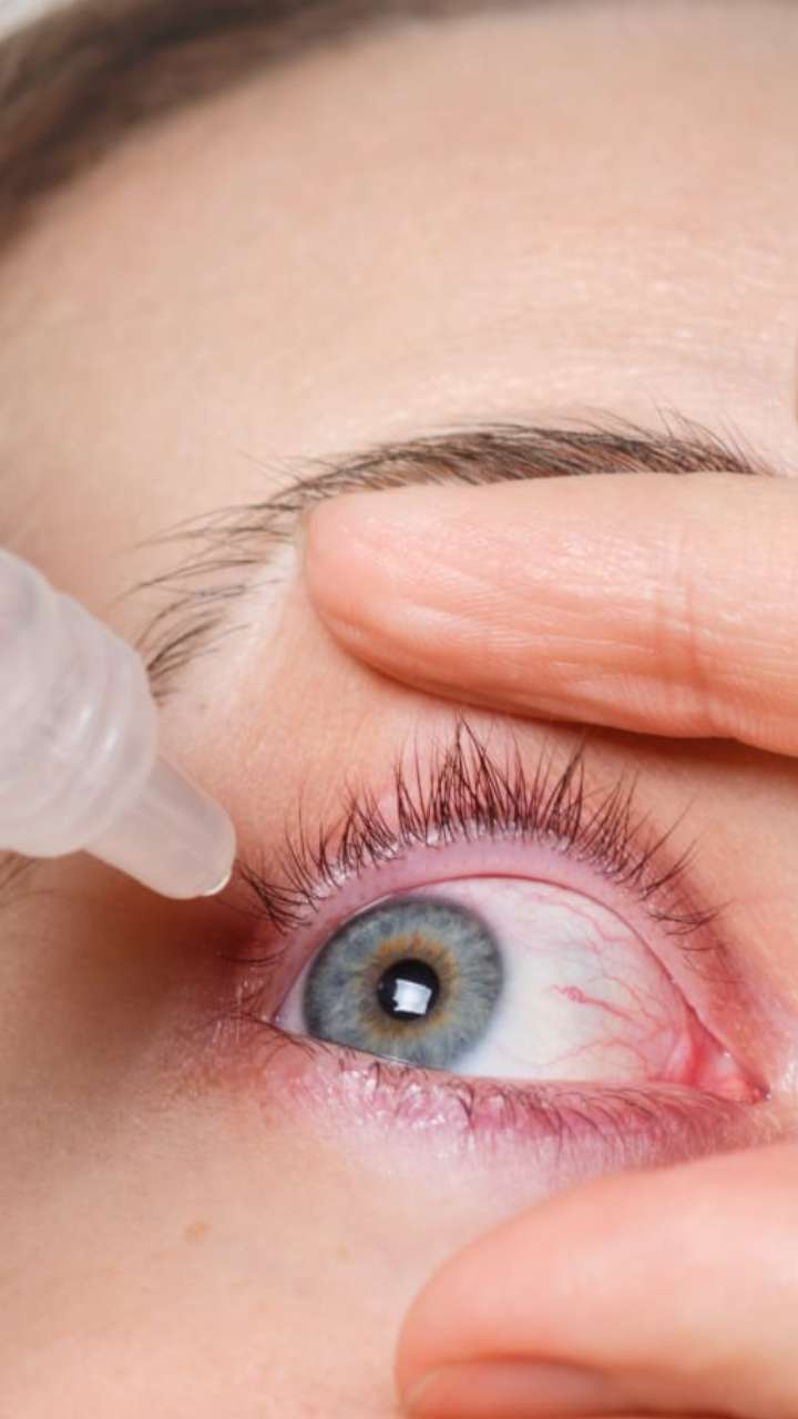 How To Prevent Viral Conjunctivitis Pink Eye Infection