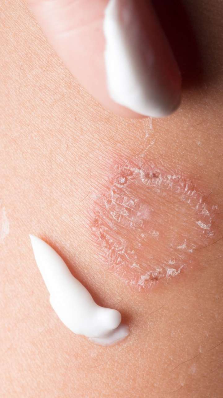 Fungal Skin Infections: Types, Symptoms, and Treatments - Healing Hospital